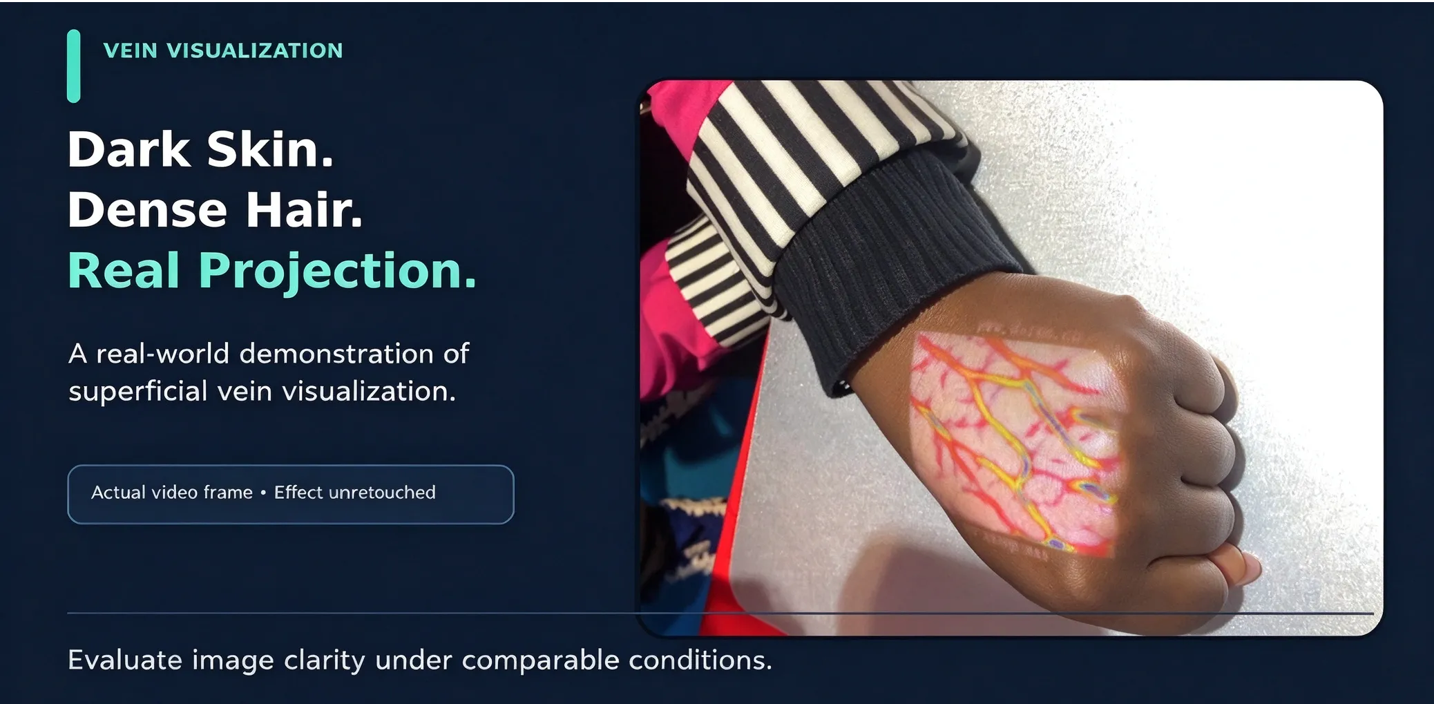 Vein Finder for Dark Skin and Dense Hair: What Should Buyers Look For? 