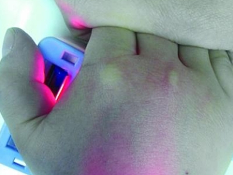 Breakthrough in Clinical Application of China's DERUK veinfinder: Precise Localization in One Second, Ending the Agony of "Blind Punctures"