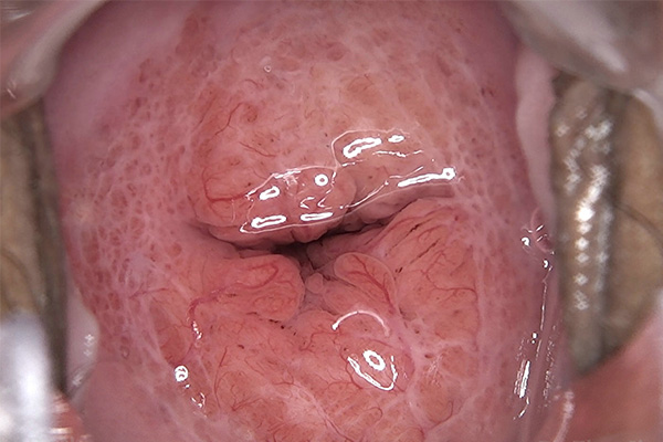 <div><span style="color:#27ae60;"><strong>Clear Cervical Lesion Display Effect Taken by Electronic Colposcope</strong></span></div> 
