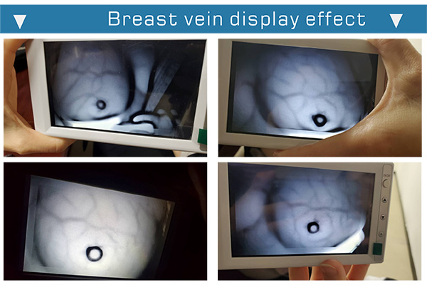 <div><strong><span style="color:#27ae60;"><span style="font-size:20px;">Breast Vein Clear Imaging</span></span></strong></div> 