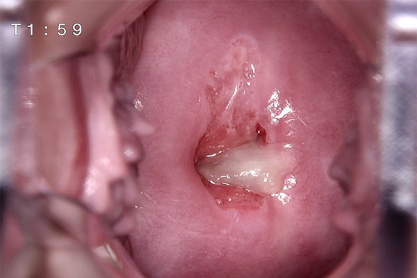 <p><strong><span style="color:#27ae60;">Digital Electronic Colposcope Real Clinical Shot of Cervical Lesion Screening</span></strong></p> 